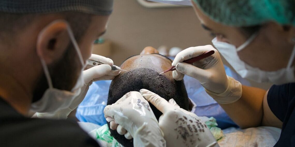 Alles Wissenswerte rund um die Haartransplantation